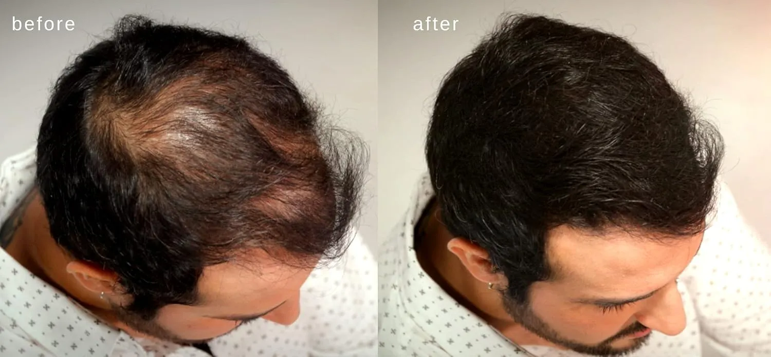 Volumizing Hair Fibers with real Keratin for Thinning Hair/Hair Loss – Dermatologist Tested and Certified Hypoallergenic - 60 days   supply - Multiple Colors Available (Black)